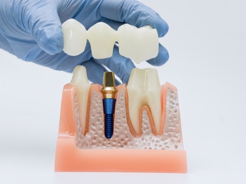 3D model showing a titanium dental implant replacing a missing tooth root.