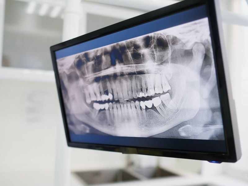 High-resolution digital dental X-ray showing full jaw structure for accurate diagnosis.